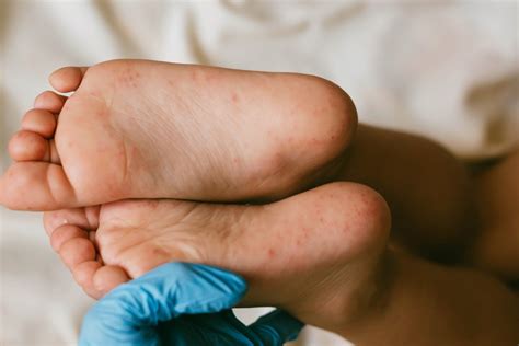 bocca mani piedi fotografie|mano piedi bocca malattia.